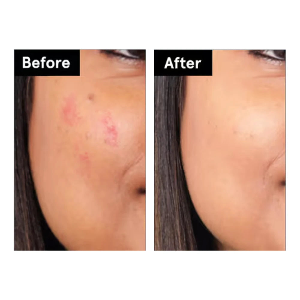 Acne LED Therapy Patches